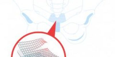 Transvaginal Mesh Implant and pelvic bone