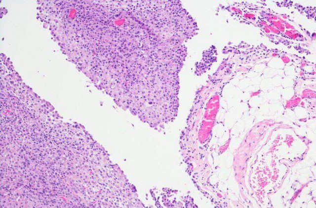 Mesothelioma micrograph