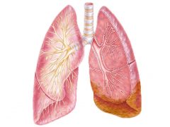 Illustration of lungs with mesothelioma