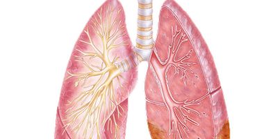 Illustration of lungs with mesothelioma