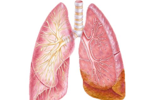 Illustration of lungs with mesothelioma