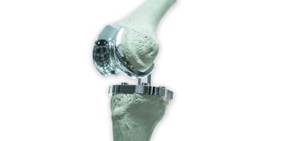 Knee replacment