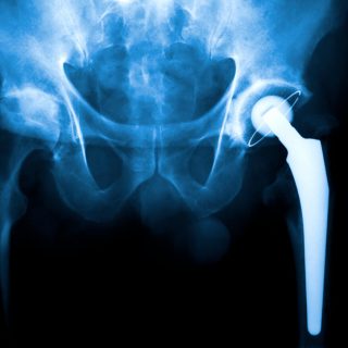 metal-on-metal hip implant
