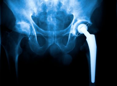 metal-on-metal hip implant