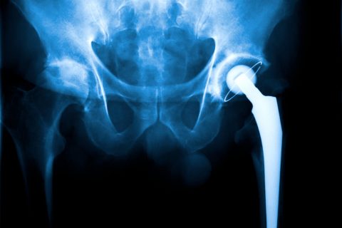 metal-on-metal hip implant