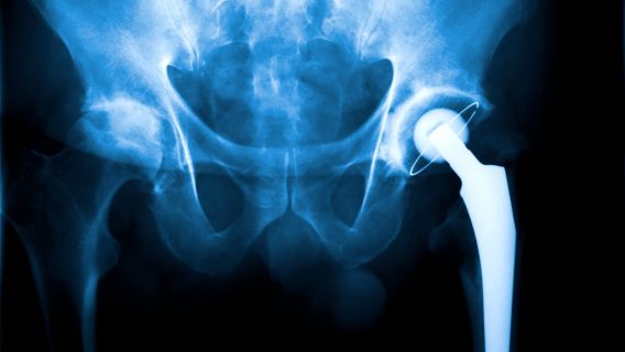 metal-on-metal hip implant