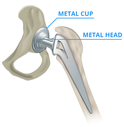 Metallosis is caused by metal-on-metal rubbing