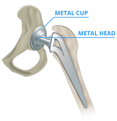 hip replacement metallosis hip replacement metallosis