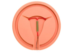 Mirena Uterine contraceptive devices (IUD).
