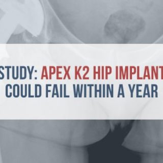 X-ray of hip implant