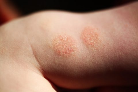 Nummular eczema on a child.