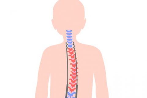 Image depicting a spine straightener implanted to fix a crooked spine