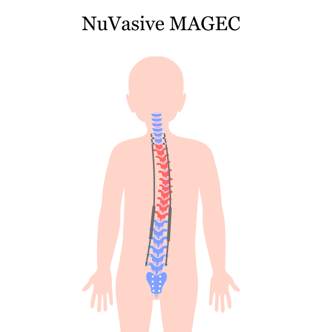 The NuVasive MAGEC system helps straighten the spine in children with early onset scoliosis (EOS).