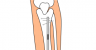 Image showing how a rod is placed to treat limb length discrepancy