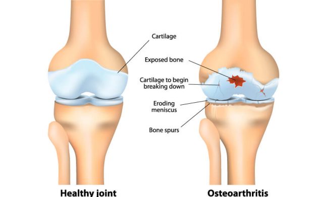 Osteoarthritis diagram