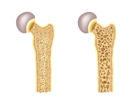 Bone With and Without Osteoporosis