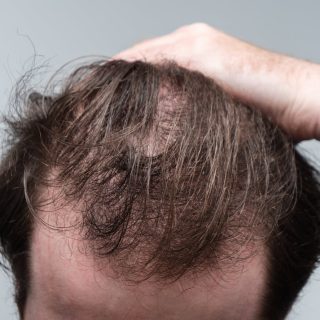 Man with hair loss