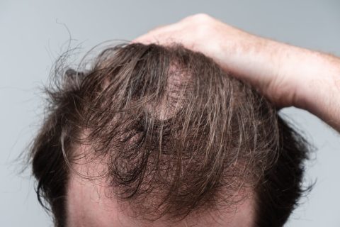 Man with hair loss