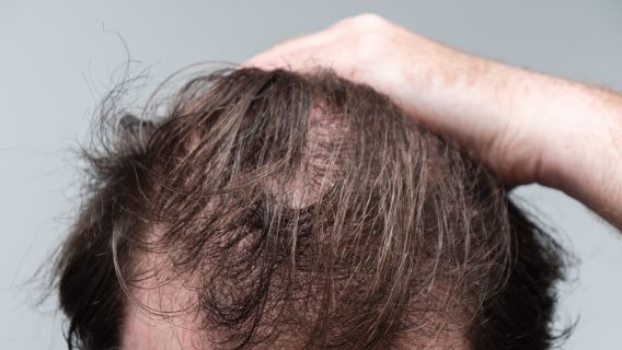 Man with hair loss