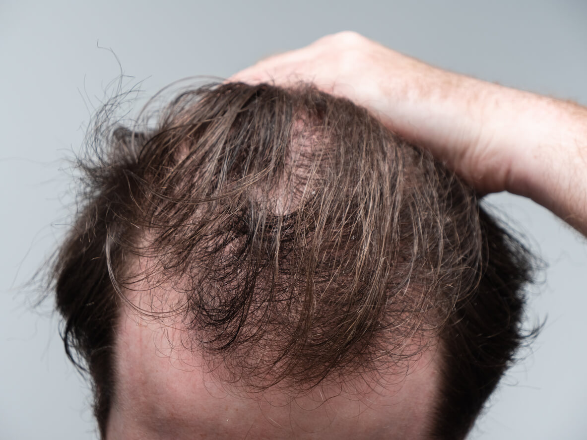 Man with hair loss