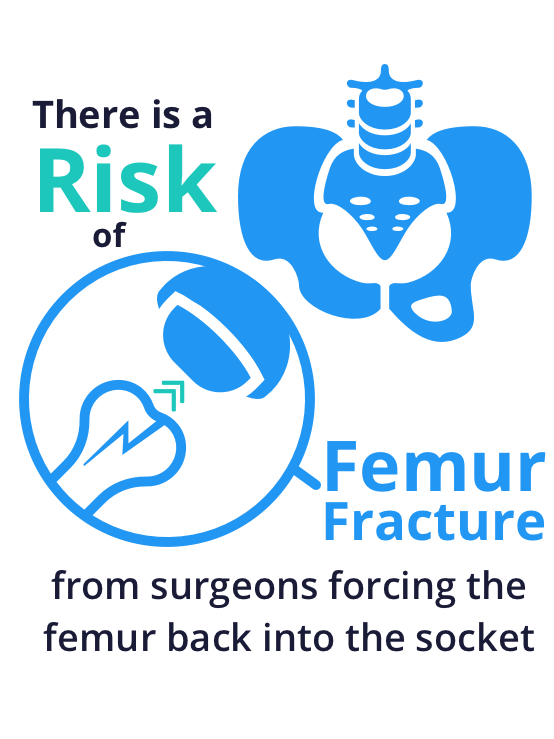 femur fracture risk from forcing back into socket