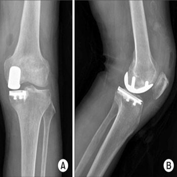 partial knee replacement xray