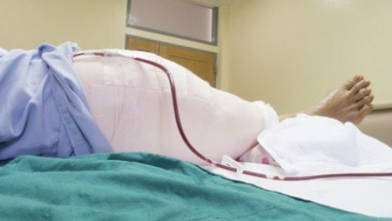 patient's leg after knee surgery