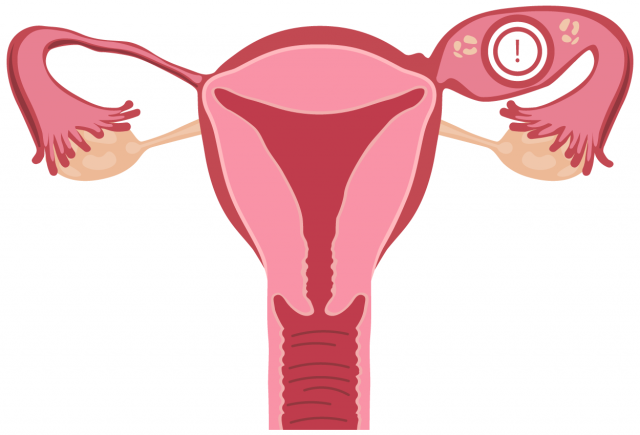 Diagram showing pelvic inflammatory disease