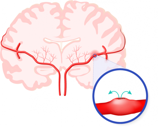 Internal brain hemorrhage illustration