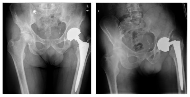 X-ray of Wright's Profemur and Conserve Hip Implants