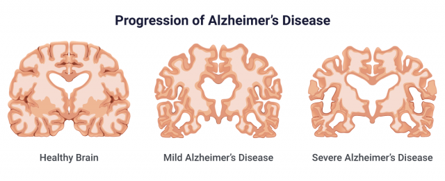 Illustration showing the progression of Alzheimer's Disease