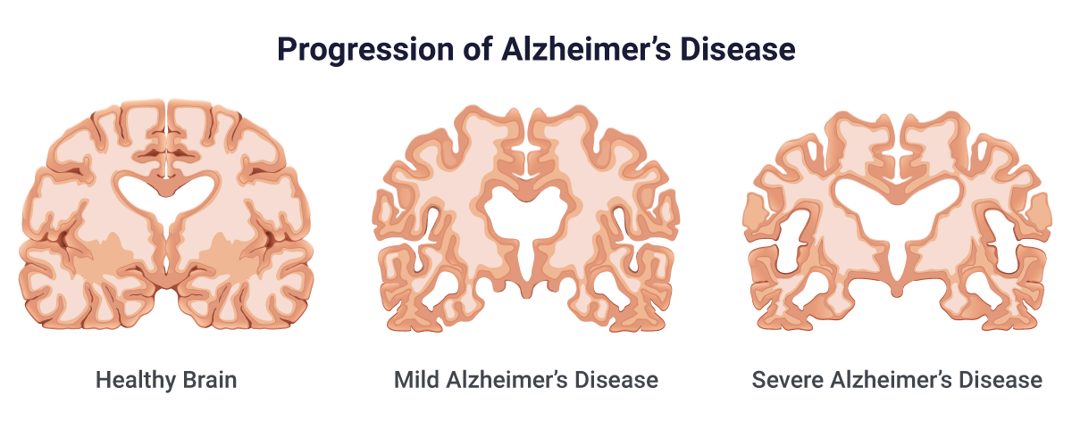 progression-alzheimers-disease.png