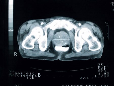 Prostate Cancer MRI View