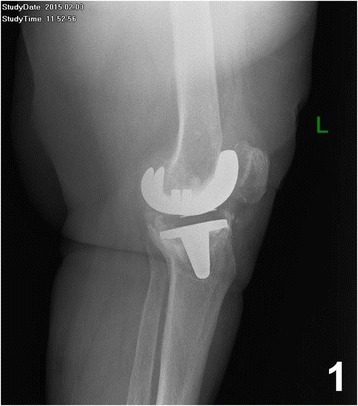 Radiography of a knee showing a loosening of the prosthesis