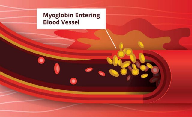 Rhabdomyolysis Graphic