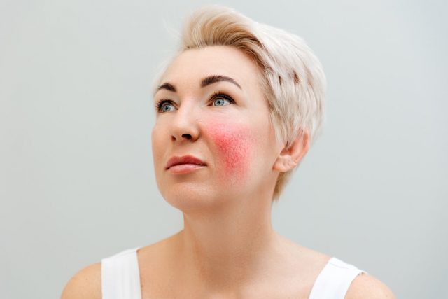 rosacea