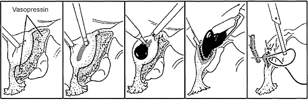 Removing Essure via Salpingotomy