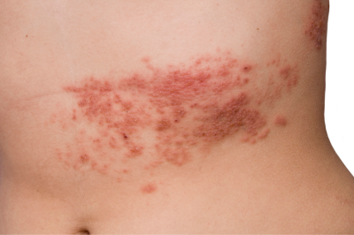 Itchy Chest: Rash, Causes, Treatment