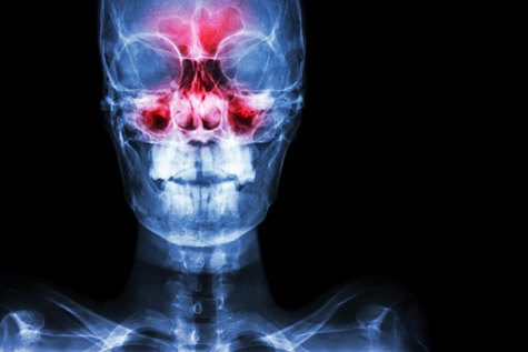 Sinusitis X-Ray