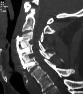 spinal compression x-ray