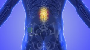 Spinal Cord Stimulator