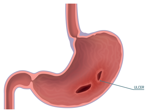 Illustration of a stomach ulcer