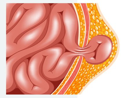 strangulated hernia illustration