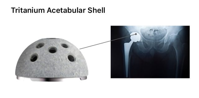 Stryker hip implant