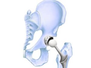 Hip Replacement — Stryker