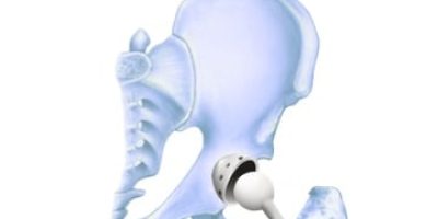 Stryker hip replacement