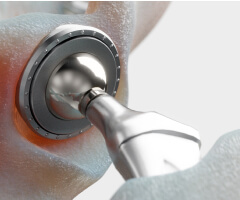 Synovo Total Hip System