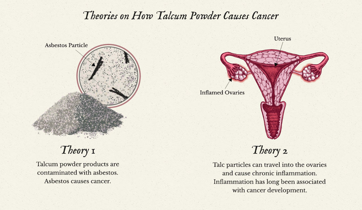 Use Talcum Powder Led to Ovarian Cancer 