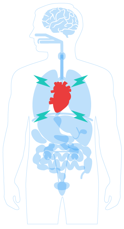 xray showing a heart attack
