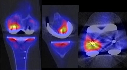 Knee Replacement Inflammation as Seen on X-Ray